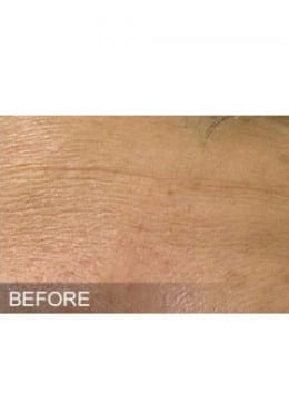 Before Image: HydraFacial - close-up