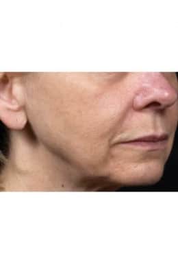 After Image: Skin Tightening - oblique right