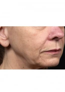 Before Image: Skin Tightening - oblique right