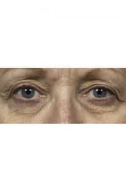 Before Image: Skin Tightening - close-up